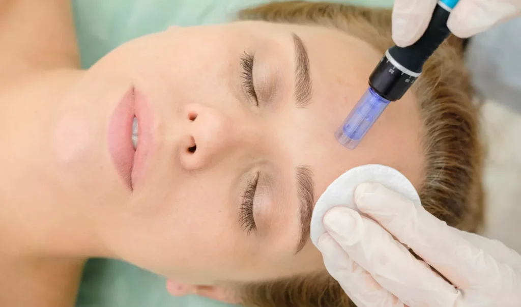 Microneedling from Medical Aesthetics BY Lacey