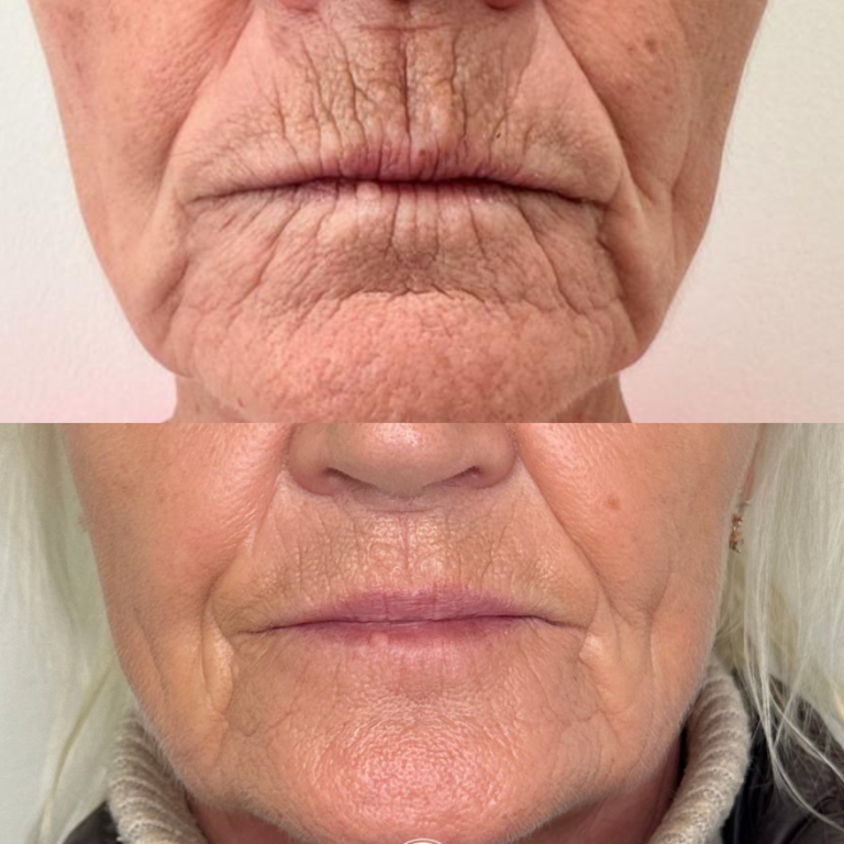 Perioral Filler